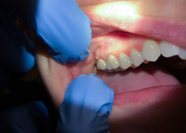 Best Emergency Dentist for Lost Fillings or Crowns in Turnersville, NJ